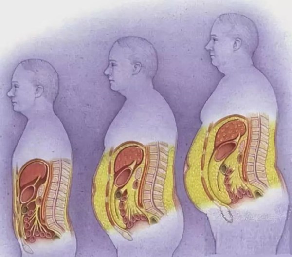 內臟脂肪對比.jpg 內臟脂肪對比.jpg